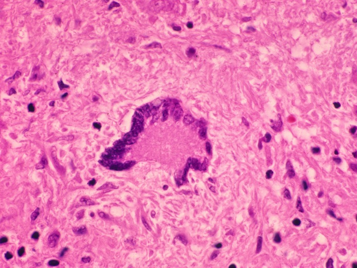 Giant cells, langhans; Langhans Giant Cells