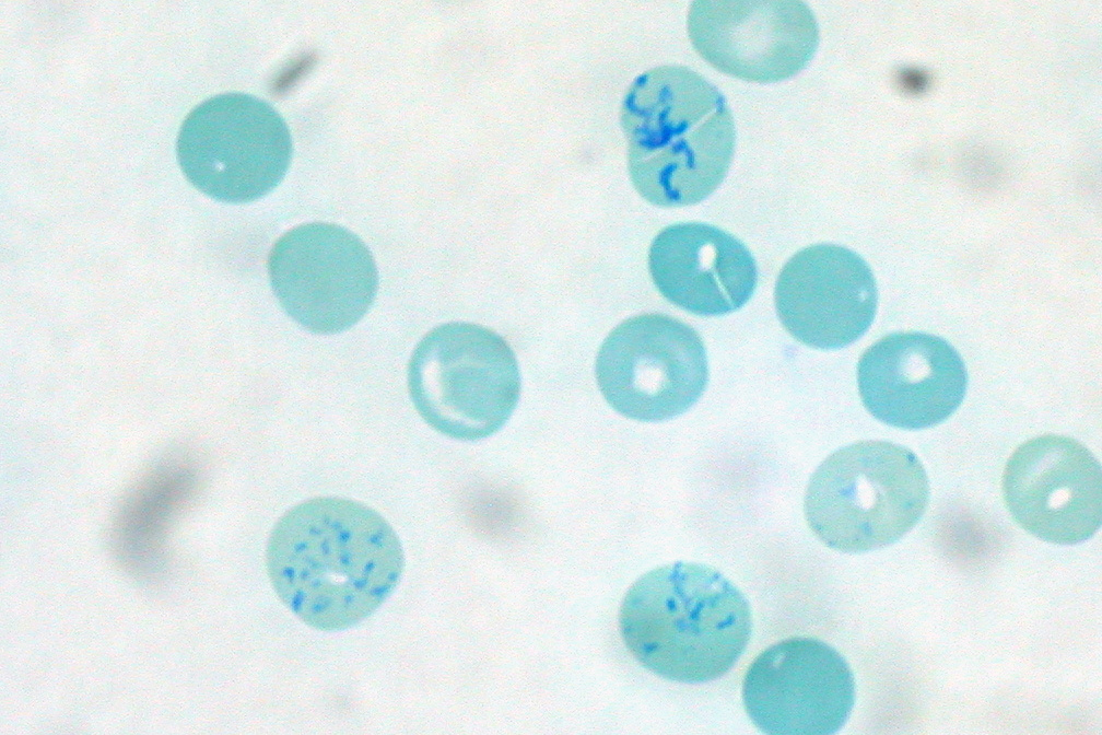 Absolute vs corrected reticulocyte count